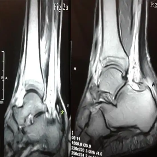 MRI Right Ankle Joint With Contrast